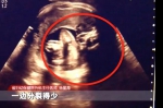 武汉一女子产下罕见胎中胎 - 新浪湖北