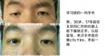 刘辅容眼整形修复研究院成立， 是眼整形失败者的福音 - Wuhanw.Com.Cn