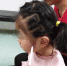 武汉5岁女童做作业时摔倒 铅笔插入脸颊4厘米(图) - 新浪湖北