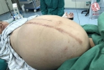 武汉男子肚子比孕妇还大 医生取出五十斤重巨型肿瘤 - 新浪湖北